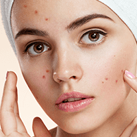 acne treatment pune